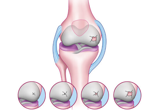 Arthrose du genou : HappyCross soulage la douleur et améliore la