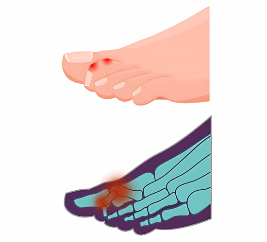 Illustration d’orteils en griffe