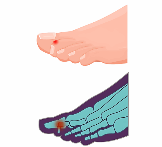 Illustration d’orteils en maillet