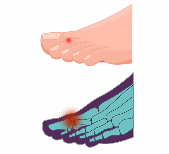 Illustration d’orteils en marteau